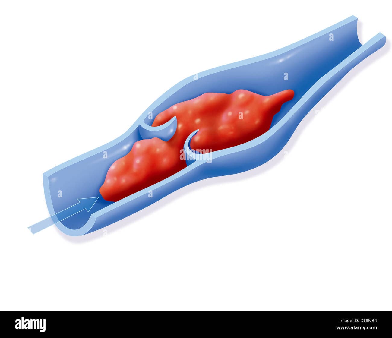 Deep Vein Thrombosis